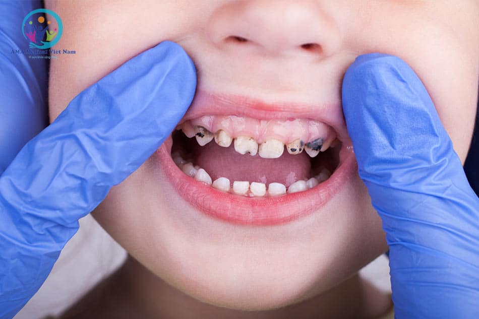 Xịt răng miệng Midkid được sử dụng cho trẻ để chăm sóc, vệ sinh răng miệng
