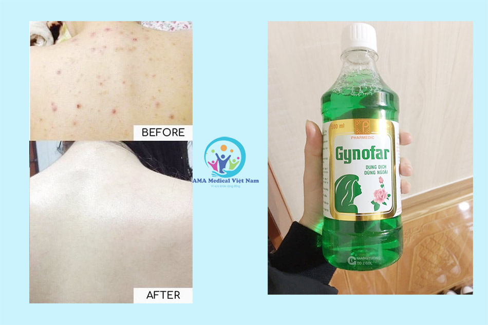 Hình ảnh khách hàng sử dụng Gynofar trị mụn lưng sau 1 tháng